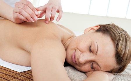 Acupuncture